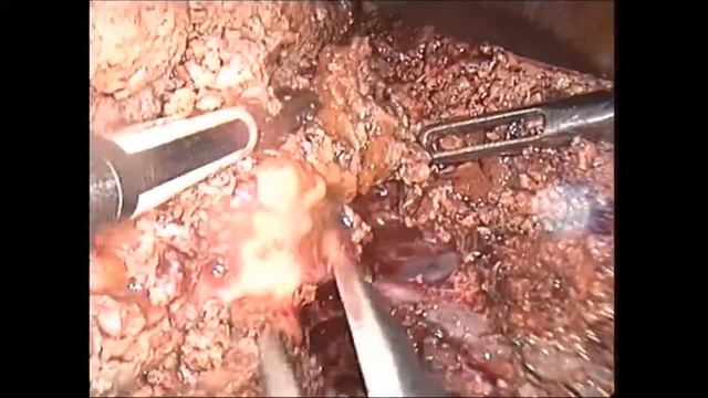Laparoscopic radical liver resection for alveolar echinococcosis смотреть онлайн