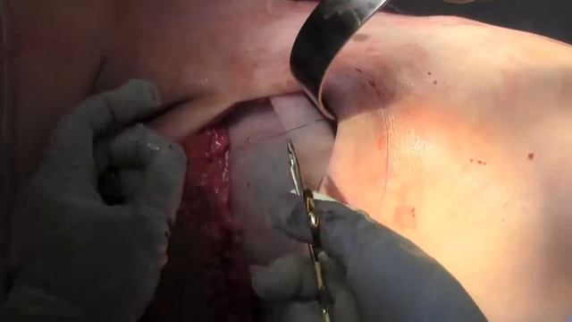 Latissimus Dorsi Flap Reconstruction смотреть онлайн