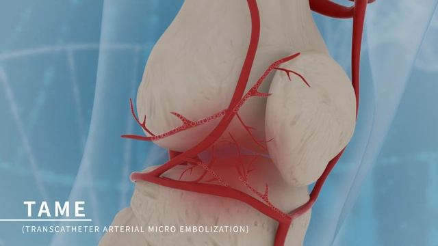 TAME : Transcatheter Arterial Micro Embolization(Smart-Gel, PL micromed) смотреть онлайн