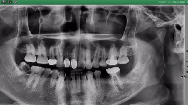 Insight Pan Cases | Proximal caries & TMJ disorder in the Anterior смотреть онлайн