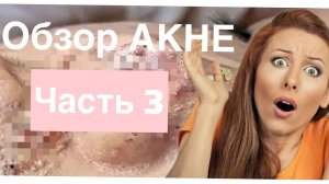 23 МЛН. ПРОСМОТРОВ - АКНЕ ПРЫЩИ УГРИ обзор видео реакция часть 2