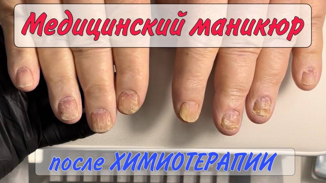 Химиотерапия _ ногти после химиотерапии _ медицинский маникюр смотреть онлайн