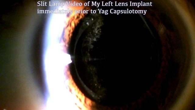 YAG Capsulotomy On My Own Eye For Treatment Of Posterior Capsule Opacification.  Surgeon's View.