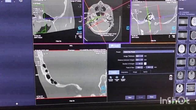CT mastoid full prosesing, Filiming,ct mastoid,Somatom.go смотреть онлайн