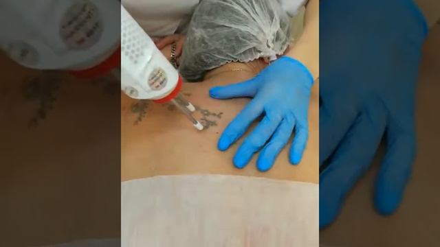 удаление татуировки неодимовым лазером смотреть онлайн