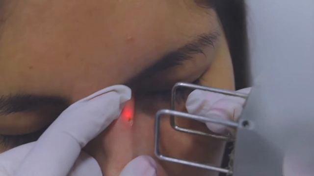 Retiro de lunar con el Laser CO2 Fraccionado DEKA - Estetica Trujillo Peru смотреть онлайн