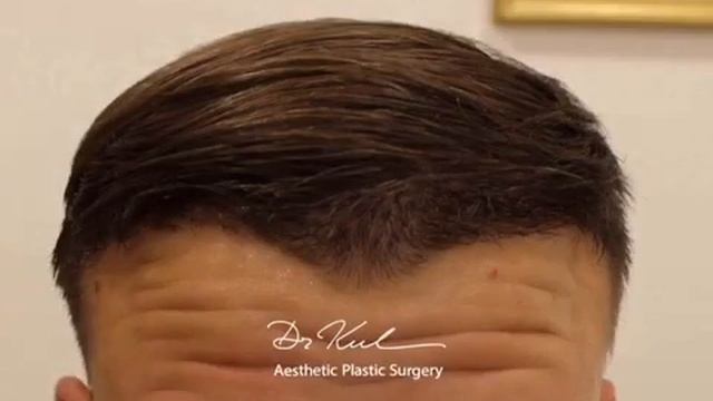 F U E & N I T 2800 Grafts смотреть онлайн