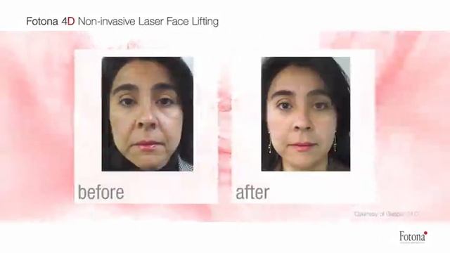 Recommended  Laser Fotona 4D Near Me SouthBank