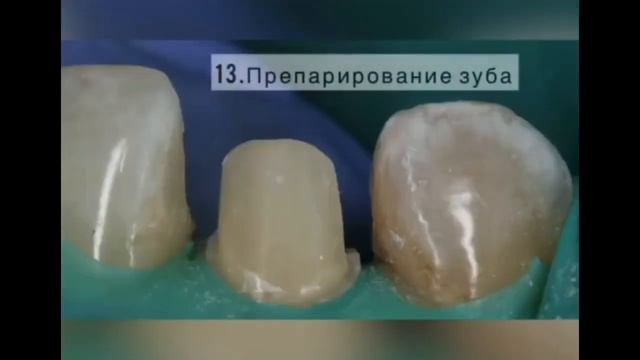 подготовка зуба и протезирование коронкой смотреть онлайн