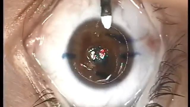 LASIK - Dr. L. Gauthier-Fournier - Cleaver for LASIK enhancement - MORIA смотреть онлайн