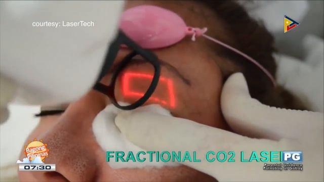 DERMAESTHETIQUE: Fractional CO2 laser смотреть онлайн