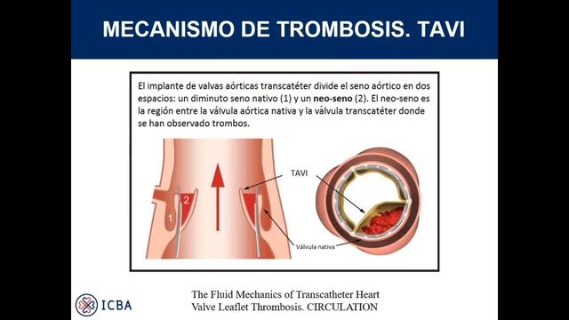 Reemplazo valvular biológico y TAVI - Discusión - 17/05/2019 смотреть онлайн