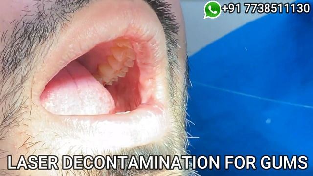 Solution For Bad Breath - Halitosis | Laser Treatment for bad breath | ozone therapy for Halitosis смотреть онлайн
