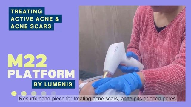 Acne Scar treatment in Ludhiana, Punjab with M22 Laser by Lumenis at Refine Aesthetic Clinic смотреть онлайн
