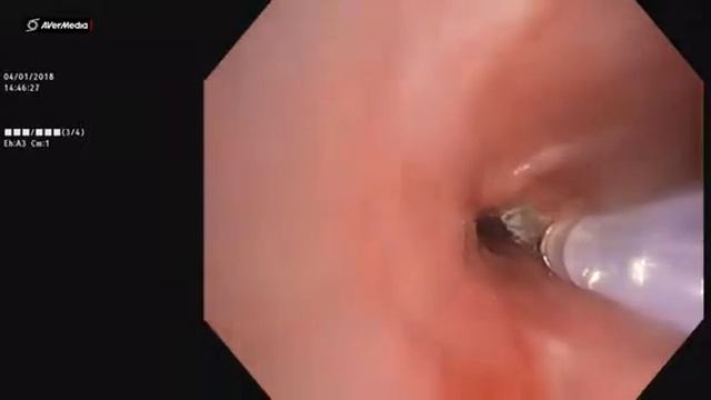 YAP Laser to treat airway stenosis смотреть онлайн