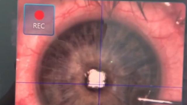 Как быстро проходит операция лазерной коррекции зрения? смотреть онлайн