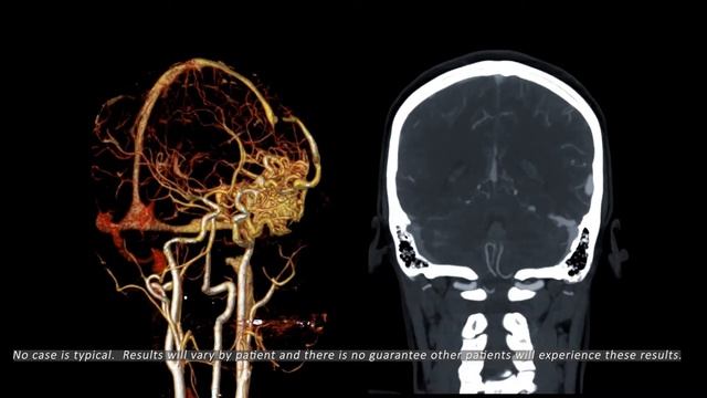 Stereotactic Radiosurgery for Arteriovenous Malformations disclaimer2 смотреть онлайн