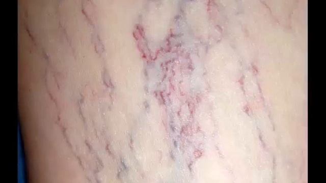 Варикоз на ногах лечение лазером смотреть онлайн