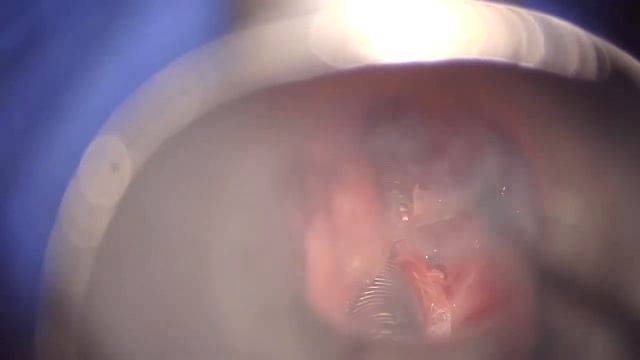 Transoral Laser Resection Laryngocoele using DEKA Laser смотреть онлайн