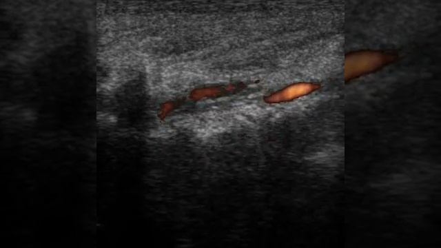 VERTEBRAL ARTERY DISSECTION смотреть онлайн