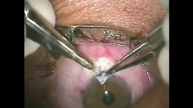 Вариант оперативного лечения при глаукоме Glaukom Operation - Prof. O. Findl, ATrabeculectomy