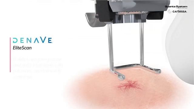 Quanta System - Denave (Product Video USA) смотреть онлайн
