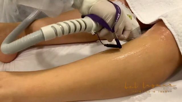 Sessão de depilação a Laser - Soprano Ice смотреть онлайн