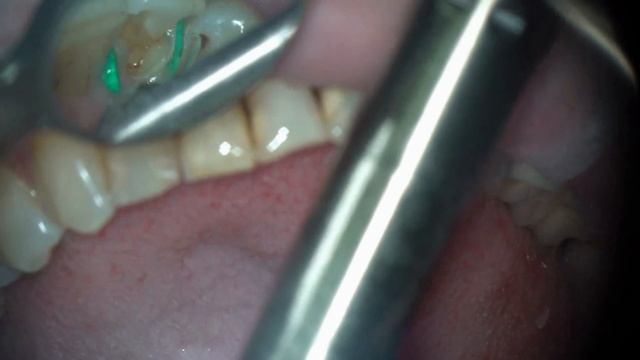 Er:YAG laser Fotona LIghtWalker caries cavity preparation смотреть онлайн