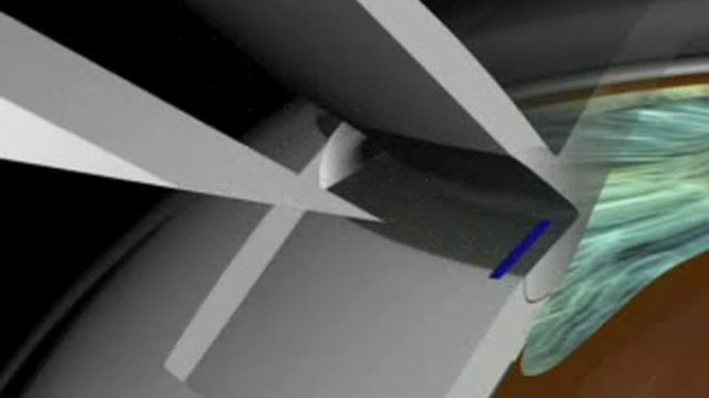 Схема оперативного лечения при глаукоме Glaukom Operation - Prof. O. Findl, Augenarzt Wien