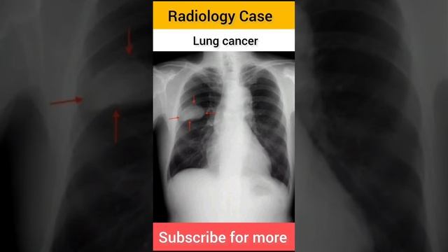 #radiographer #paramedical #question #radiologycase #radiology #carcinoma #cancer #aiims #radio смотреть онлайн