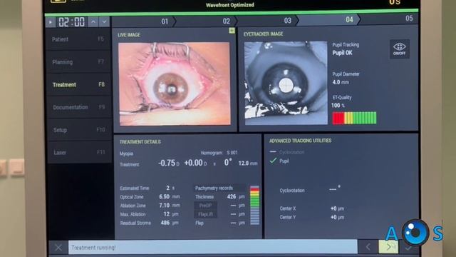 Contoura PRK & Corneal Crosslinking for Treatment of Keratoconus / Irregular Astigmatism смотреть онлайн