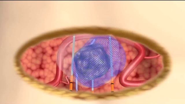 Nanoknife——Advanced Tumor Ablation Technology смотреть онлайн
