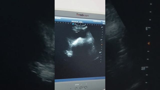 Intestinal Obstruction post operative смотреть онлайн