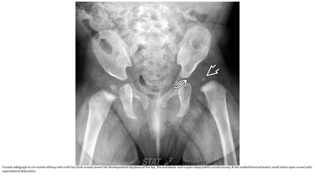 Developmental Hip Dysplasia-Review