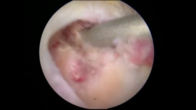 ROTATOR CUFF REPAIR avi смотреть онлайн