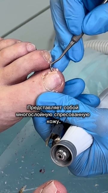 С проблемой поможет справиться подолог. Больше о здоровье ногтей у нас на канале 📲 ПОДПИСЫВАЙТЕСЬ смотреть онлайн