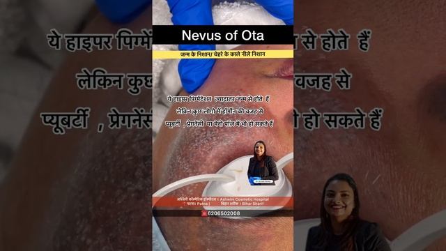 Nevus Of Ota | Nevus Of ITO | Birth mark | Pigmentation on Face| Dr Achala Verma| Q Switch Laser смотреть онлайн