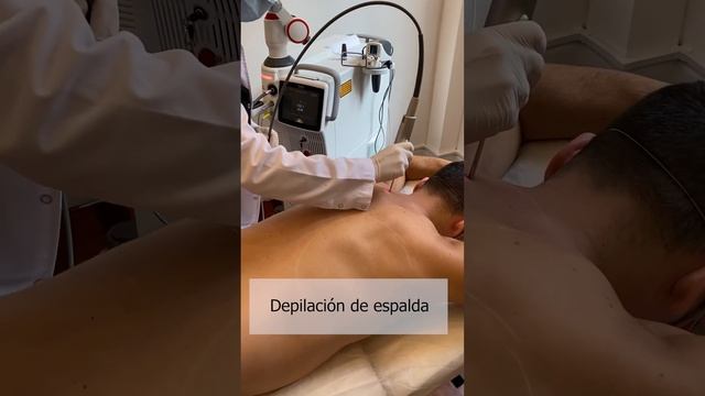 Depilación Laser - Marcación de Barba y espalda - Laser Fotona смотреть онлайн