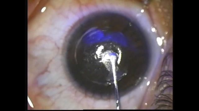 Femto SMILE Part 2 Alaa Eldanasoury смотреть онлайн