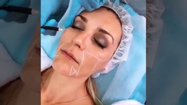 Ультразвуковая без болезненная подтяжка лица. смотреть онлайн