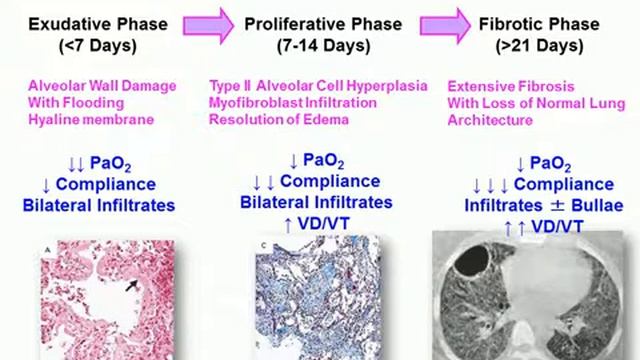 LIMITATIONS OF CURRENT APPROACHES TO DIAGNOSE OR PREDICT ARDS