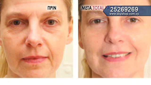 Total Face Lift