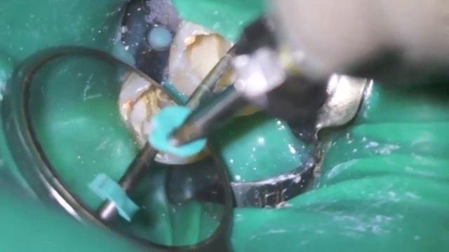 DR NAYEF YOUNIS C-SHAPED MOLAR OBTURATION смотреть онлайн