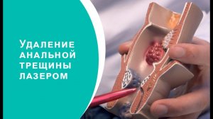 Удаление анальной трещины лазером