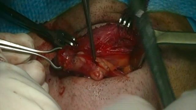 Submandibular Salivary Gland Excision - Pleomorfic Adenoma смотреть онлайн