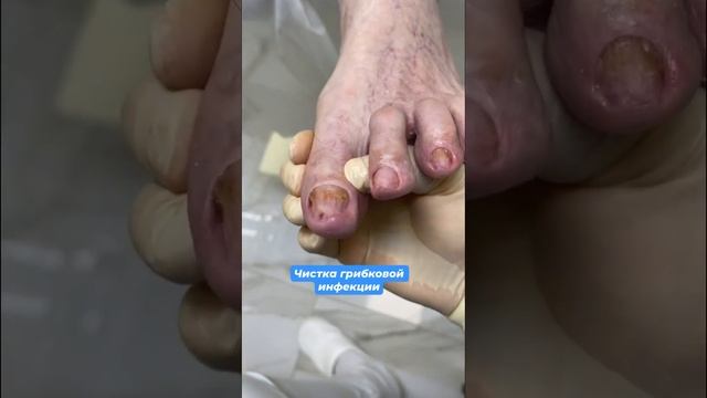 Осторожно , грибы #подологмосква #грибокногтей смотреть онлайн