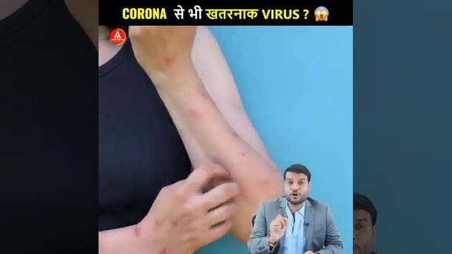 Will Monkey Pox dangerously spread in India like Corona Virus #shorts смотреть онлайн