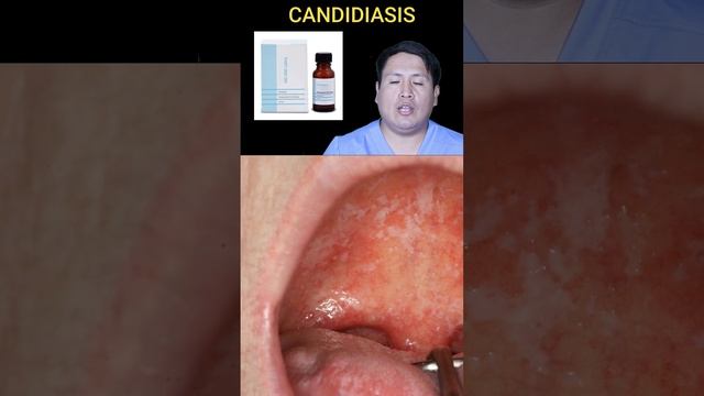 TRATAMIENTO DE LA CANDIDIASIS ORAL смотреть онлайн