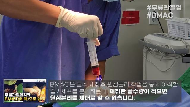 무릎관절염치료? 자가골수줄기세포 BMAC으로! смотреть онлайн