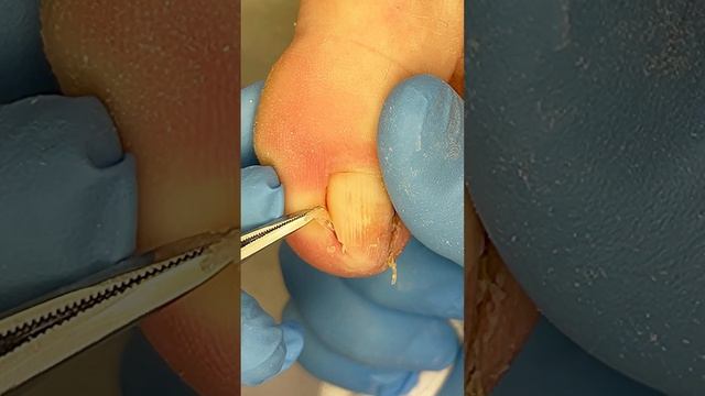 Вытянуть то что болит #мозоли #подногтем смотреть онлайн